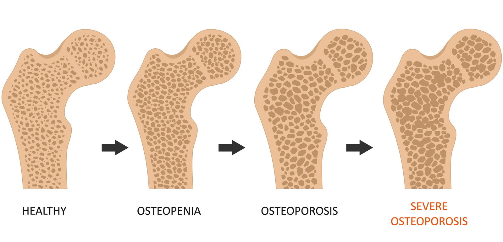 Razlika med osteopenijo in osteoporozo