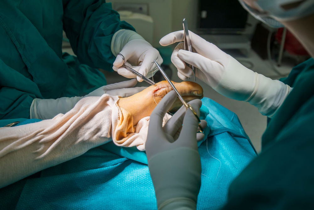 Operacija hallux valgus